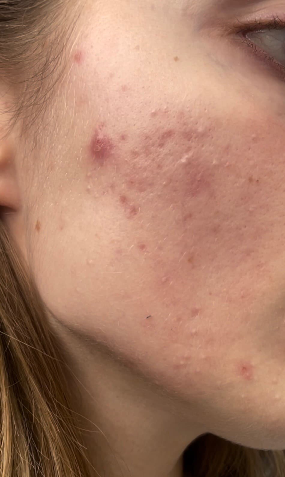 XVesuvius Wins Men's Health Award for Revolutionary Acne Treatment